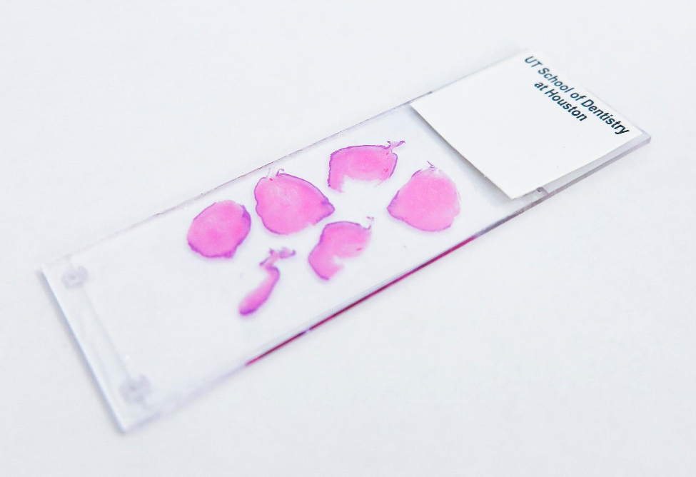 Tissue slide developed from a biopsy.